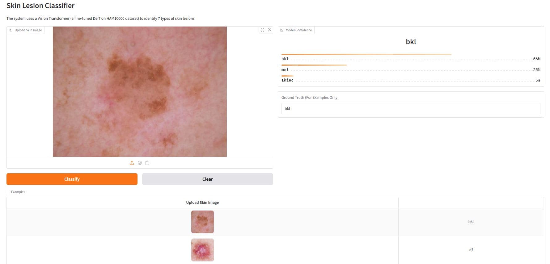 Skin Lesion Classifier